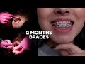 2 MONTH BRACES UPDATE + CHANGING WIRE VLOG