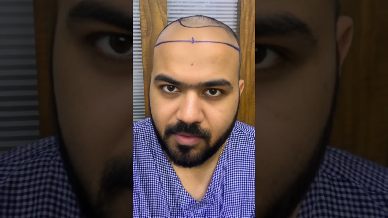 Hair Transplant Result in Gujarat | Natural Hairline & Density