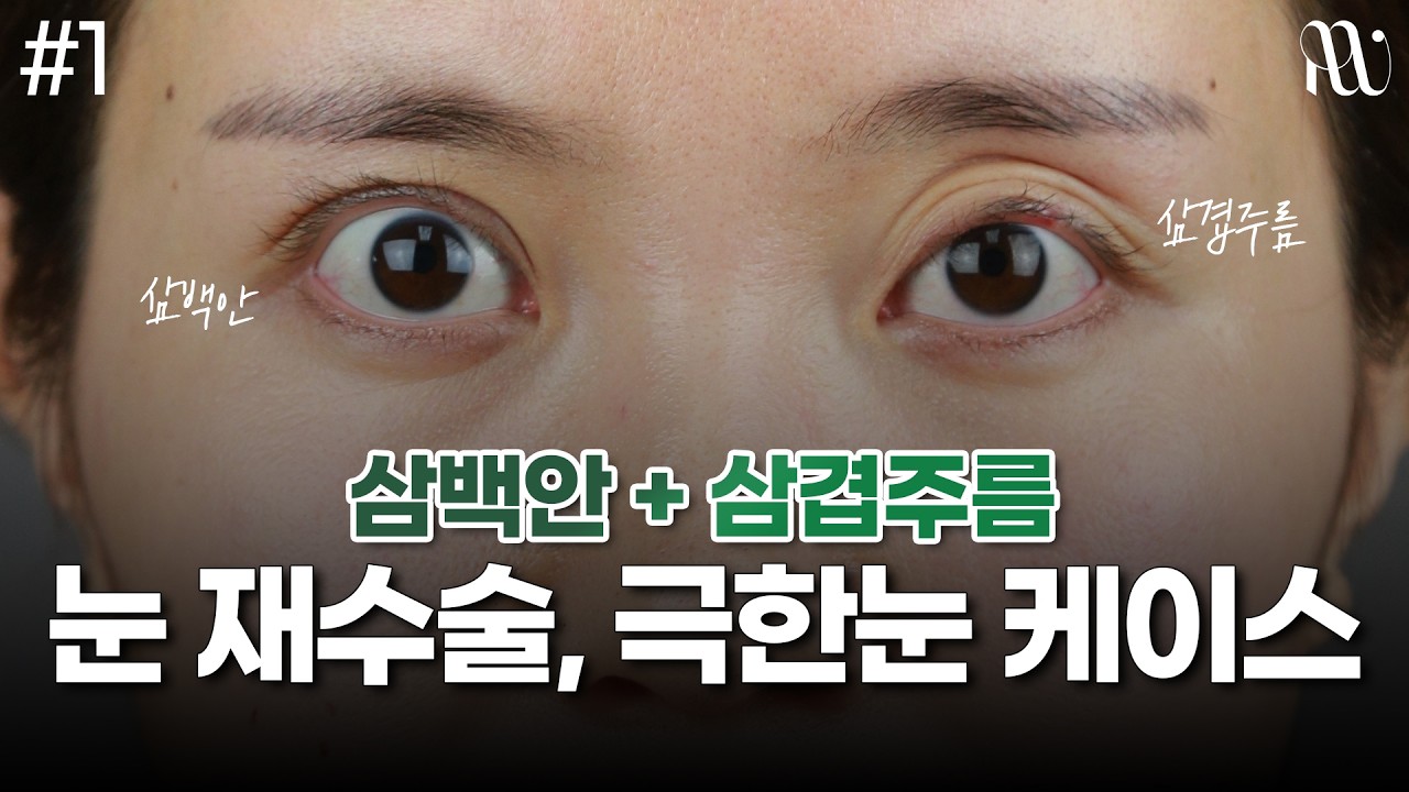 삼백안+삼겹주름 눈재수술, 극한 눈 케이스 살펴보기