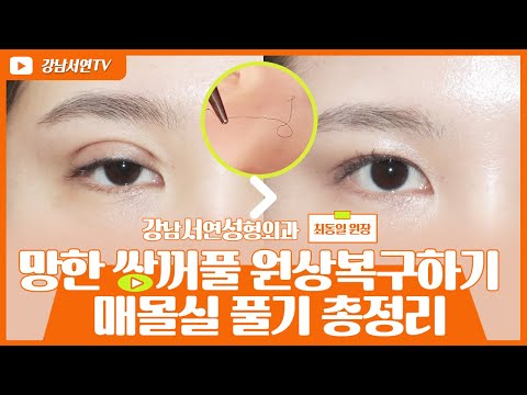 성형탐구 I 매몰실 제거, 매몰쌍꺼풀 풀기 총정리! 수술방법, 수술전후, Q&A까지