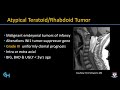 Imaging Pediatric spine tumors