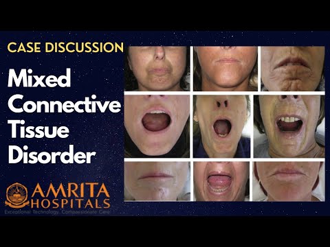 Case Discussion || Mixed Connective Tissue Disorder