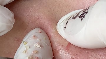 Acne Treatment For "Hung" (P21) | Điều Trị Mụn Cho Hùng (P21) - SacDepSpa#240