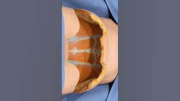 Hoe een buikwandcorrectie overtollige huid verwijdert (3D-animatie)