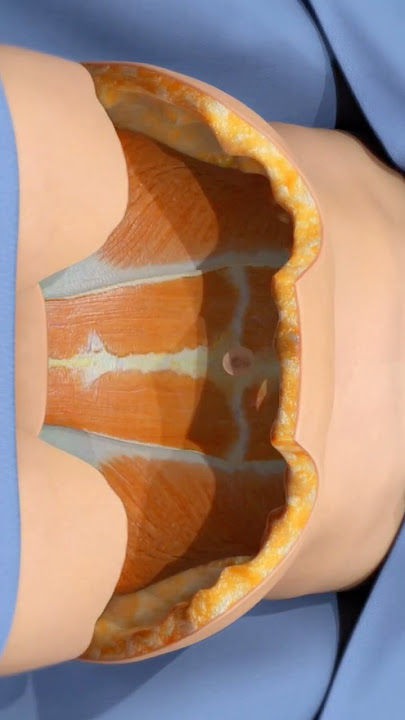 How a tummy tuck removes excess skin (3D Animation)