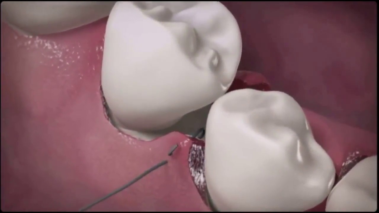 Detailed Step-by-Step Suturing Techniques -  Animated Video