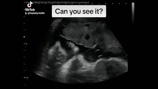 2D Ultrasound of Baby at 32 Weeks 1 Day Pregnant!