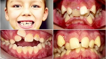 Răng Mọc Lệch Ở Trẻ Xử Lý Như Thế Nào | Nha khoa Vân Anh