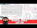 Rate and Rhythm | Normal Sinus Rhythm