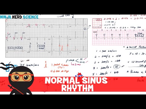 Video: Ritme Sinus: Ritme Sinus Normal, Aritmia Ritme Sinus