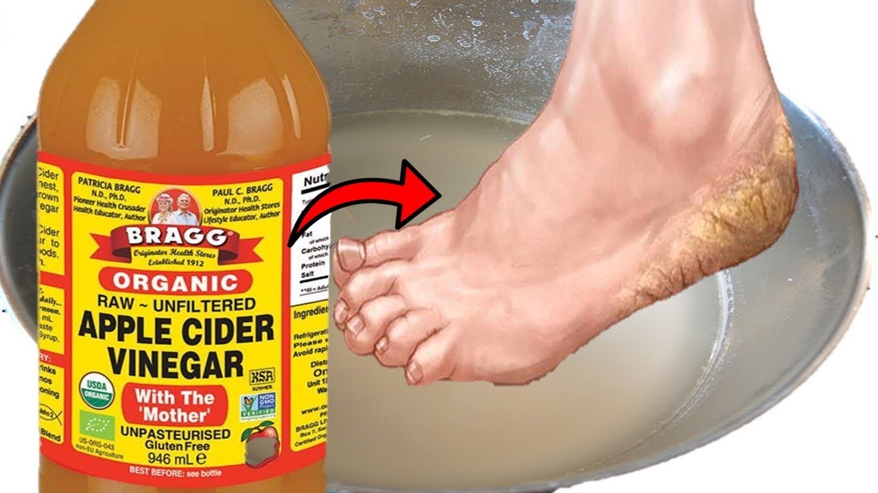 13 Home Remedies For Toenail Fungus & Best Prevention Tips