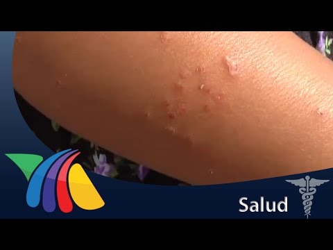 Video: ¿Las alergias te darán fiebre?