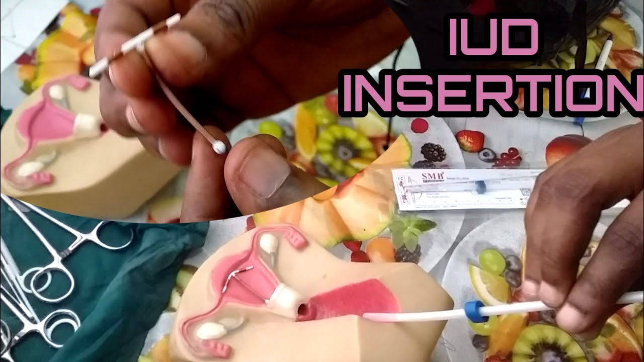 HOW THE IUD IS INSERTED[Family planning methods] - YouTube
