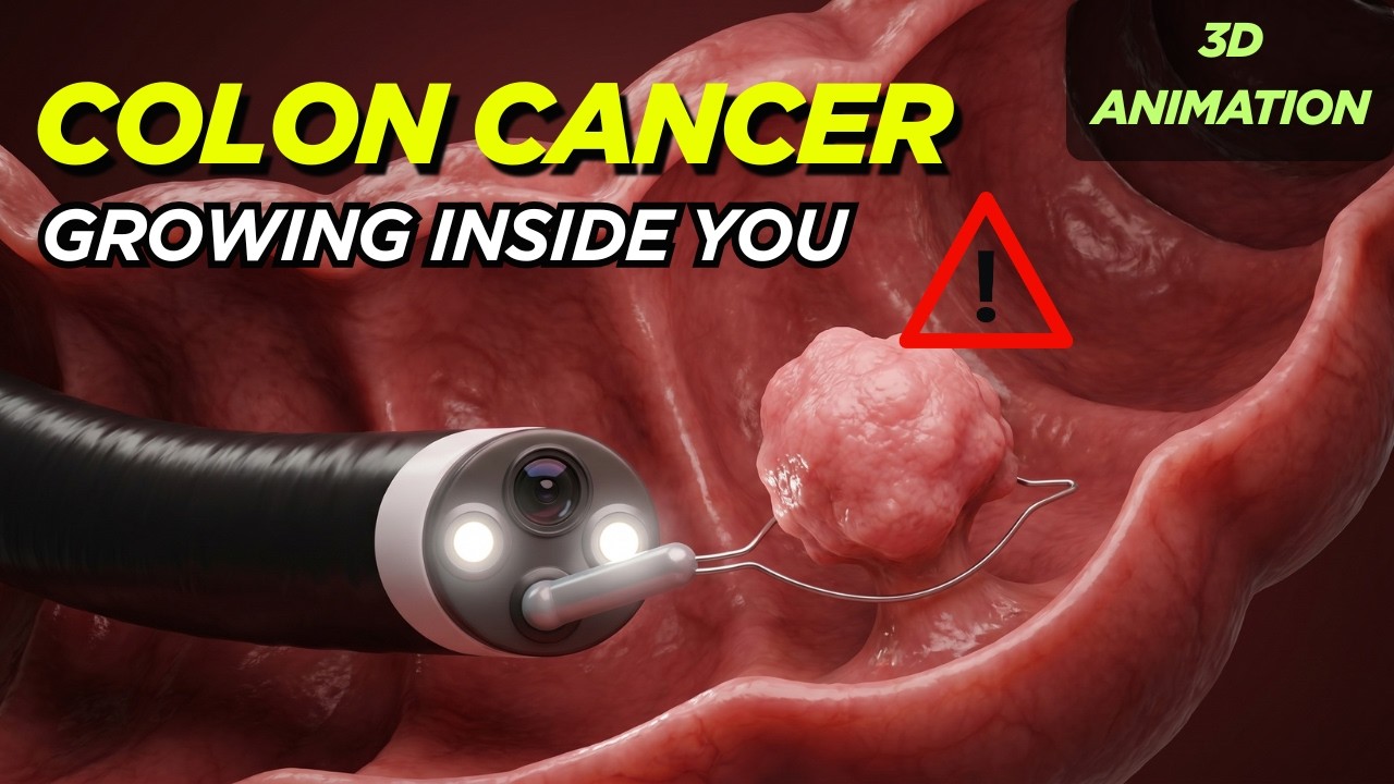 What happens during and after a colonoscopy? | 3D medical animation ...