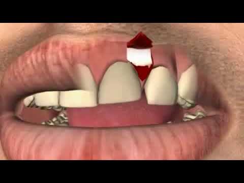 Video: Čo je to zubná fistula?