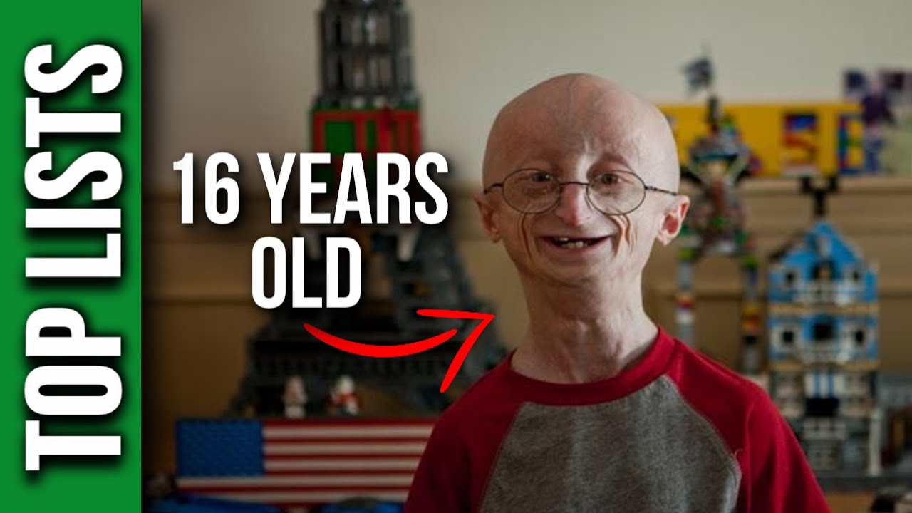 10 Most Interesting Rare Diseases YouTube