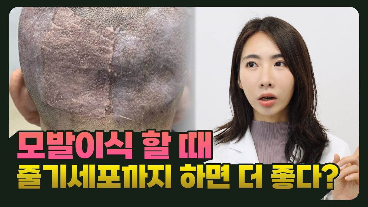 모발이식, 왜 줄기세포까지 해야 할까요?