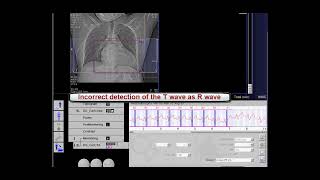 CT ECG Editing For 2