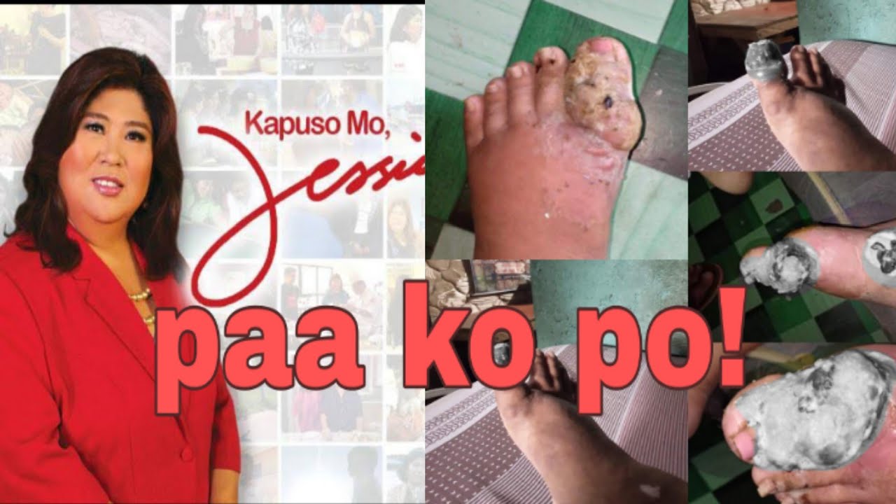 paa nagka sugat sugat at nag nana pa matapos mag pedicure. - YouTube