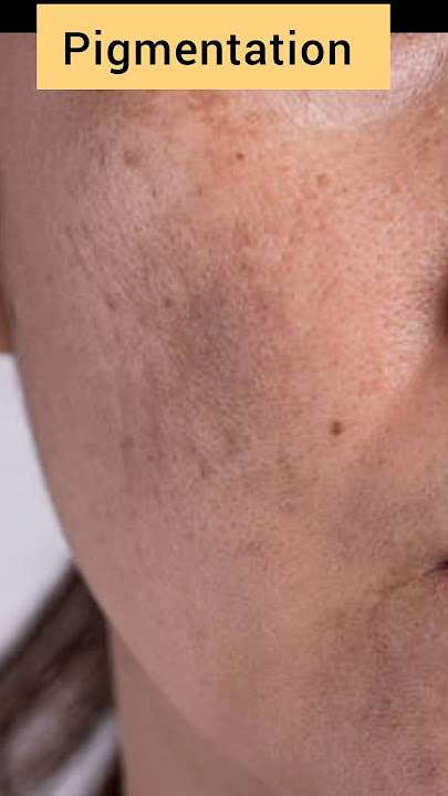Skinoren Cream 20% Azelaic  #skincare #azelaicacid #acne #skinoren #shorts #short #viralvideo