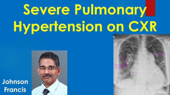 Pulmonary Hypertension Xray pulmonary-hypertension-xray