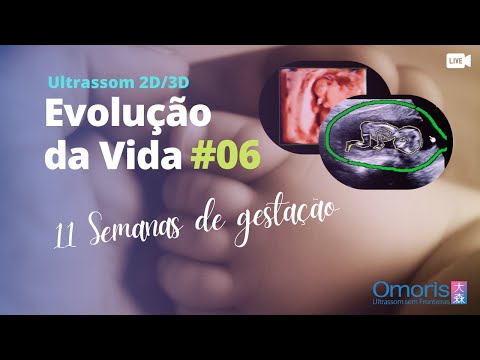 Gravidez semana a semana AO VIVO - Ultrassom 11 semanas - Evolução da Vida #06