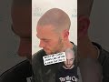 Hair loss transformation hairloss scalpmicropigmentation smp beforeandafter hairtattoo hair