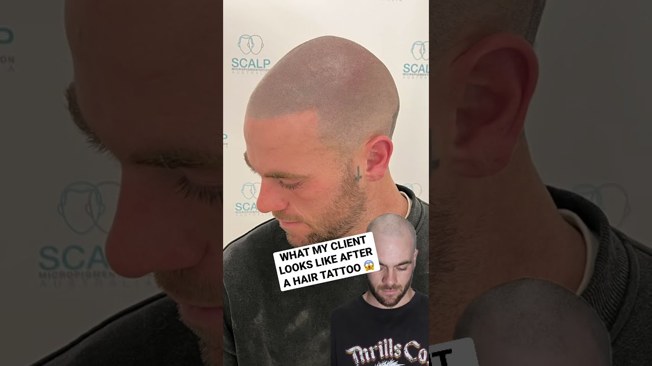 Hair Loss Transformation Hairloss Scalpmicropigmentation Smp Beforeandafter Hairtattoo