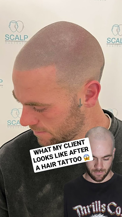 Hair Loss Transformation! #hairloss #scalpmicropigmentation #smp #beforeandafter #hairtattoo #hair