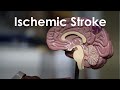 Ischemic Stroke and Transient Ischemic Attack for USMLE Step 1 and Step 2