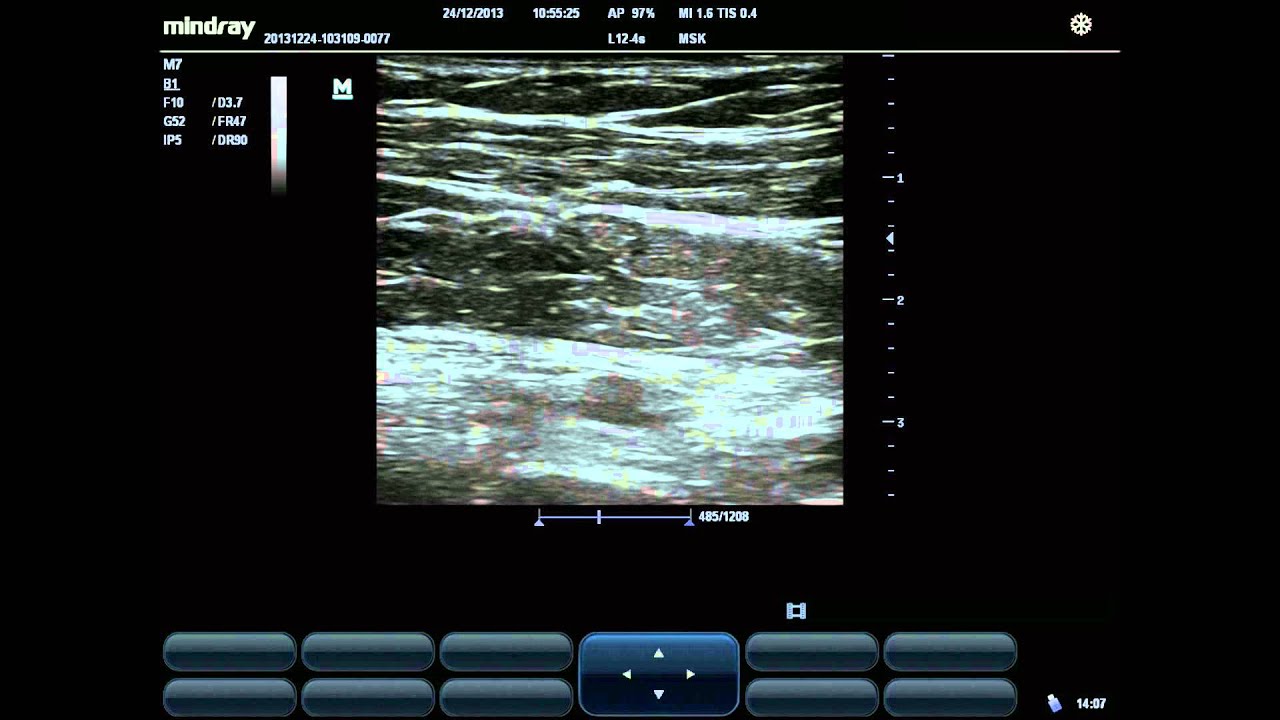 pec block
