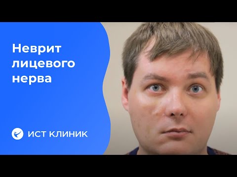 Лечение неврита лицевого нерва. Причины и симптомы пареза.