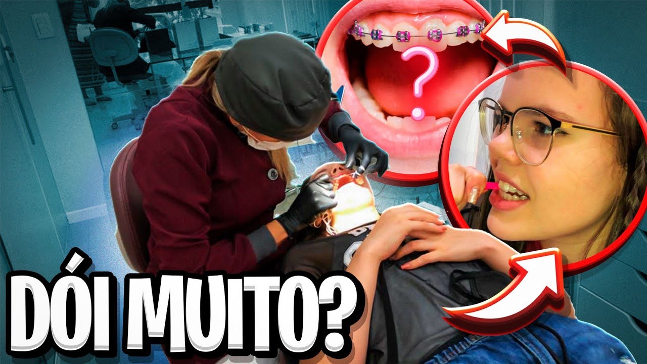 COLOCANDO APARELHO ORTODÔNTICO - DOEU MUITO??