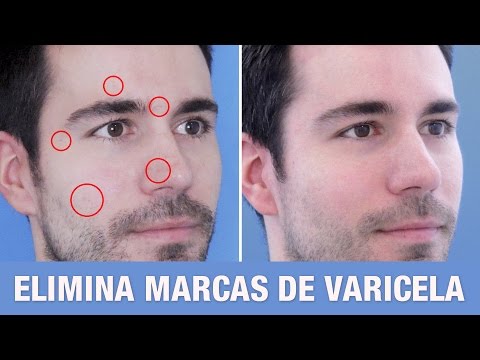 Video: 3 formas de tratar las cicatrices de la varicela