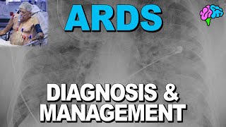 Diagnosis and Management of Acute Respiratory Distress Syndrome (ARDS)