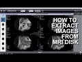 How to extract images from a mri dicom disk