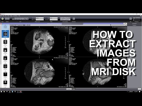 Video: Das Vorverarbeitete Connectomes-Projekt-Repository Mit Manuell Korrigierten T1-gewichteten Anatomischen MRT-Daten Mit Schädelentfernung