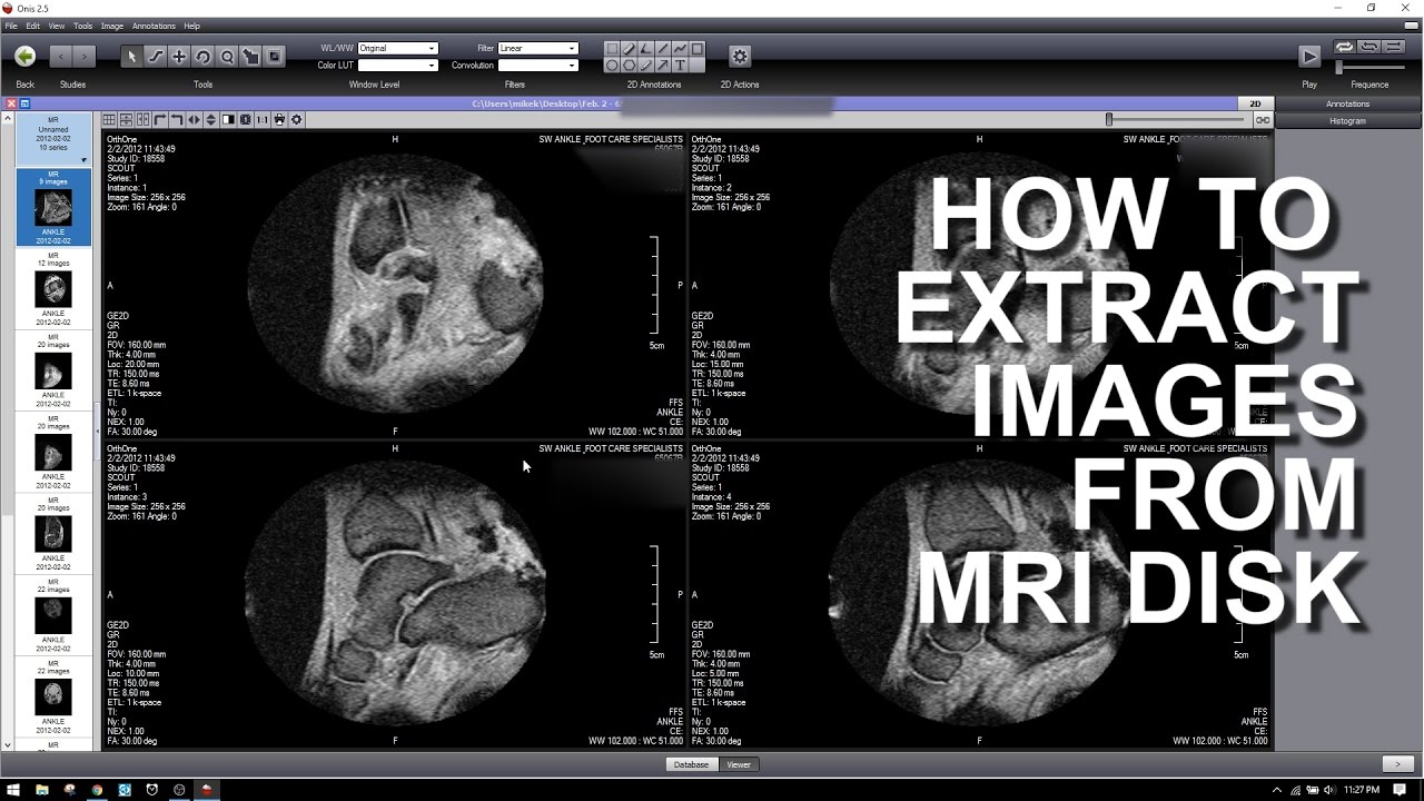 How To Extract Images From A Mri Dicom Disk