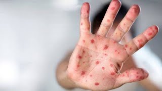 Топ-10 самых смертельных болезней в мире