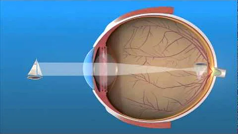 Nearsightedness (Myopia) - DayDayNews