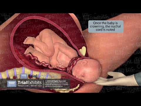 Video: Nuchal cord ni nini?