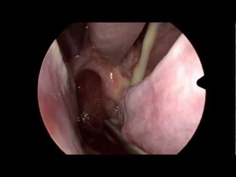 Acute Sinusitis in HD