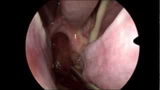 Acute Sinusitis in HD