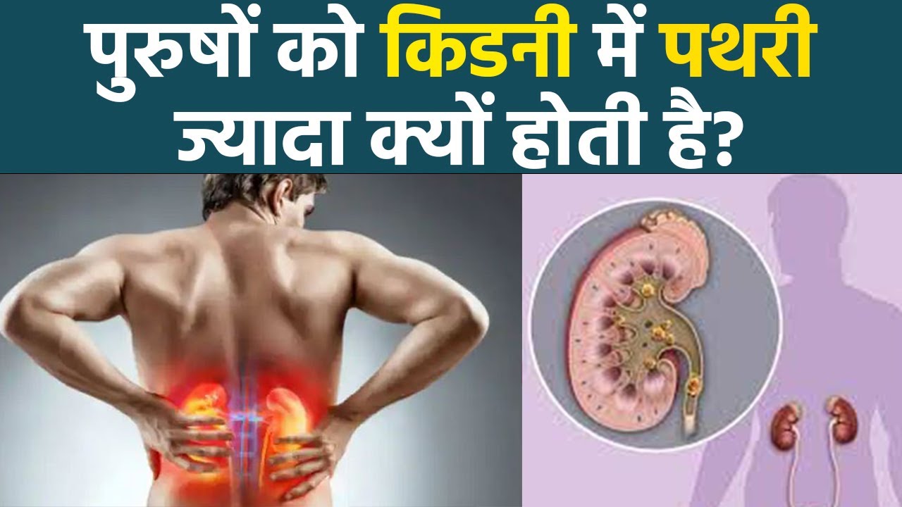 पुरुषों को किडनी में पथरी ज्यादा क्यों होती है। Pursho Ko Kidney Me