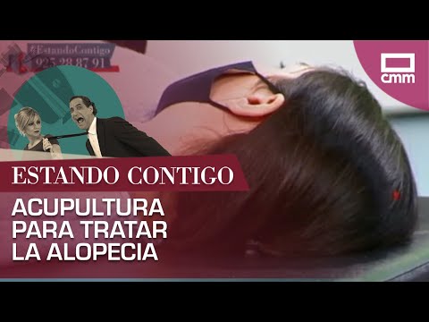 Tratamos la alopecia con acupuntura | Estando Contigo