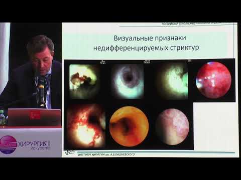 24 Старков ЮГ Цифровая холангиоскопия SpyGlass Boston Scientific