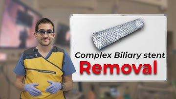 How to retrieve a challenging biliary stent?