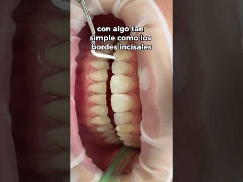 Mira lo que logramos con bordes incisales 😭🦷✨
