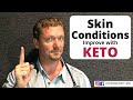 9 Skin Conditions Improved with KETO - 2021 (Acne, Eczema, Psoriasis...)