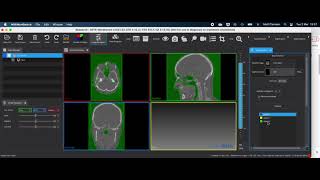 MPHY0026 Lecture7, Segmentation: OtsuThresholding